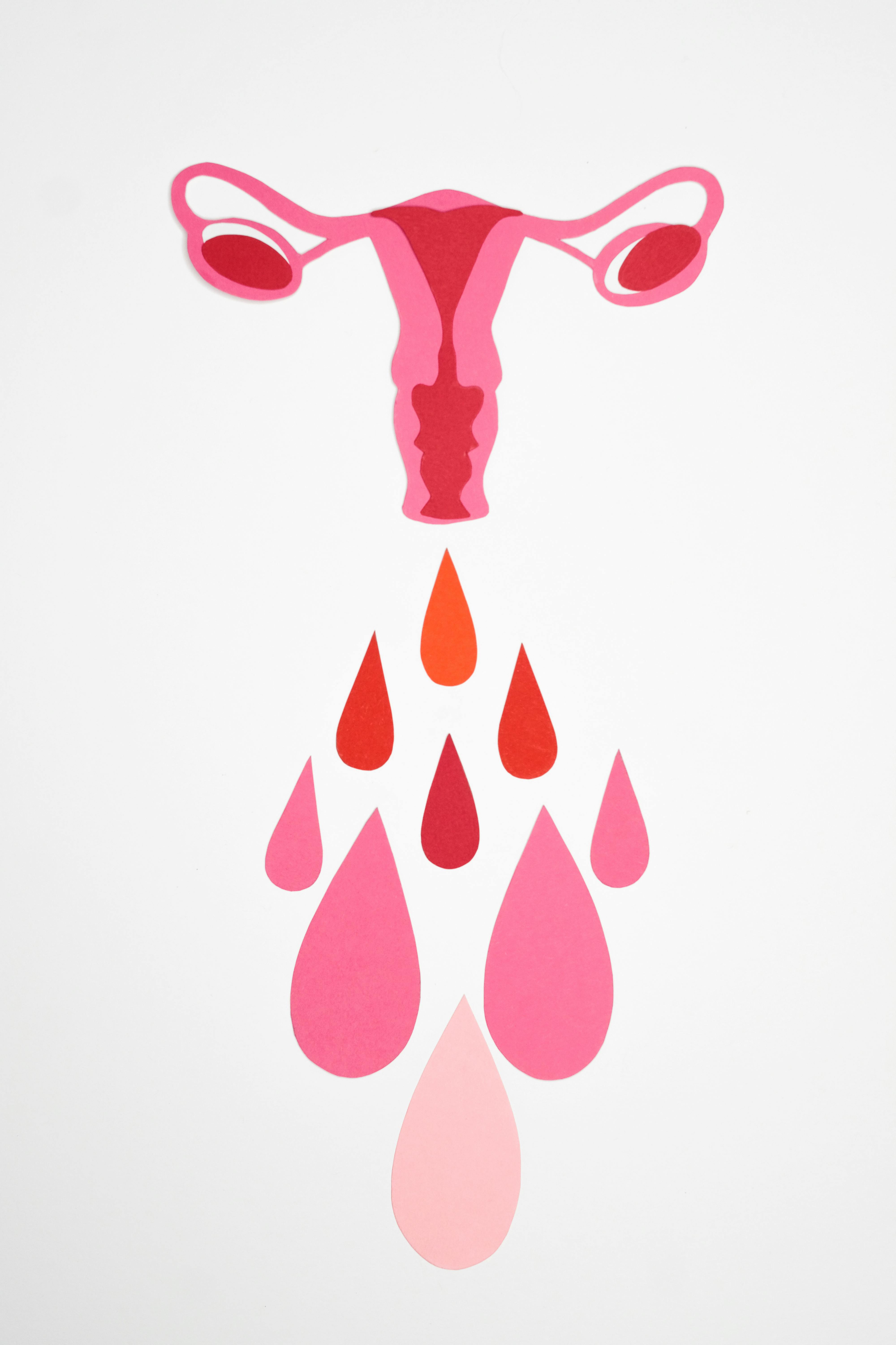 Women's Health -Understanding Polycystic Ovarian Syndrome (PCOS): Can it be cured?